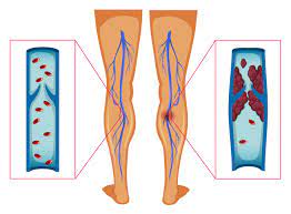 Lowering The Risk Of Dangerous Blood Clots Health Concepts