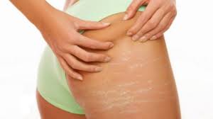 Stretch mark bisa terjadi pada pria maupun wanita, tapi umumnya, kondisi ini sering dialami oleh ibu hamil setelah ia melahirkan. 15 Cara Menghilangkan Stretch Mark Di Paha Secara Alami Klubwanita Com