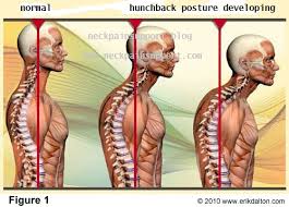 The right and left subclavian arteries give rise to the thyrocervical trunk. What Is The Hump On The Back Of My Neck Neck Pain Support Blog