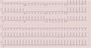 Image result for Ventricular Fibrillation Management in the Adult