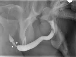 Image result for Retrograde Urethrogram