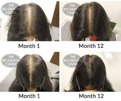 Certain environmental triggers can accelerate hair thinning, such as sun exposure, over styling, and overuse of shampoos and hair products 11. Pin On Hair Growth Remedies