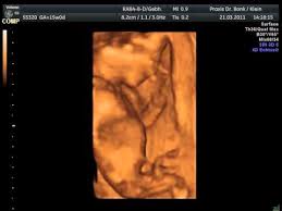 3d Ultraschall Bei 15 0 16 Ssw Youtube
