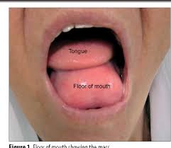 Image result for Sialolithiasis