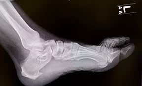 Broken bones (also called fractures) in the foot are very common. When There Is A Traumatic Fracture Of The Inferior Heel Spur Podiatry Today