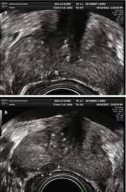23.05.2012 · transrectal ultrasound (trus) was first developed in the 1970s. Diagnostic Ultrasound Imaging Of The Prostate Radiology Key