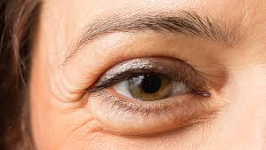 Das unterstützt die naht, wenn die wunde ungünstig liegt oder eben gar nicht genäht werden muss. Tranensacke Entfernen Methoden Ablauf Und Kosten Bei Medidate