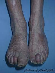 An Update On The Epidemiology Diagnosis And Treatment Of Leprosy Intechopen