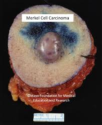 This problem occurs normally on elderly people and those who are. Merkel Cell Carcinoma Mayo Clinic Proceedings