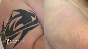 Surgical tattoo removal & tattoo excision in london, harley street. Laser Tattoo Removal London As Seen On Bbc London Pulse Light Clinic London