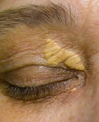 Image result for xanthelasma of eyelid