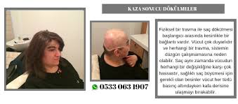 Kaza Sonucu Sac Dokulmeleri Hairhotel