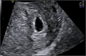 At 5 weeks (already!), your baby is as large as a sesame seed. Pregnancy Week 5 Care Symptoms The Birth Company