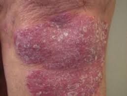 Image result for psoriasis