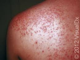 Image result for sweat rash on back