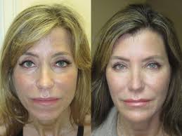 Botox & Restylane