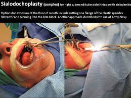 For a sialendoscopy procedure, an endoscope is placed into the salivary glands through the salivary ducts. Relevant Anatomy For Sialendoscopy April 16 2015 Columbia Missouri Iowa Head And Neck Protocols
