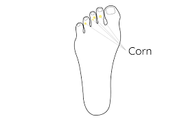 Check out amazing foot artwork on deviantart. What Is Foot Corn Foot Corn Causes Symptoms And Treatment