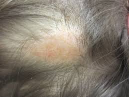 Scalp sebum doesn't necessarily cause hair loss, but if it is excessive then it can lead to issues with the overall health of your hair. Nevus Sebaceous Wikipedia