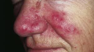 Many researchers attribute skin diseases to nutrient imbalances within the body and that correcting skin a skin disease is considered to be anything that causes abnormality of the skin. Skin Disorders Pictures Causes Symptoms Treatments And Prevention