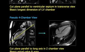 Pseudo 2 4 Chamber Views Short Axis View 4 Chamber View Left 2 Chamber View 3 Chamber View Left Ventricular Outflow Tract Mitral Valve Cardiac Mri