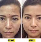 L acn de la femme adulte et ses traitements : Dr Sylvie Olive