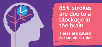 The two types of hemorrhagic strokes are intracerebral (within the. Ischaemic Stroke Stroke Association