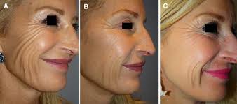 It affects human beings and animals; Accordion Wrinkle Treatment Through The Targeted Use Of Botulinum Toxin Injections Springerlink