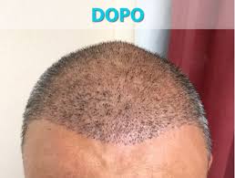 Il trapianto di capelli in turchia raccontato dal nostro paziente italiano. Trapianto Di Capelli In Turchia La Nuova Frontiera Con Tecniche Fue Divina Hair