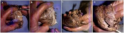 The numbers of diagonal and obtuse marginal branches were counted. Anatomical Indicators Of The Heart And Coronary Arteries An Anthropometric Study Biomedical Research And Therapy