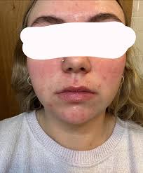 Is my face too oily with multiple creams?