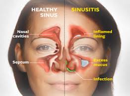 Nasal discharge, due to any cause such as rhinitis, sinusitis , nasal allergy, coupled with in chronic form, there is induration of vestibular skin with painful fissures and crusting. Understanding Sinus Infections Sinusitis Health Life Media