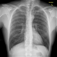 The inner lining of the chest wall is the parietal pleura. Rib Fractures Right 4th 6th Radiology Case Radiopaedia Org
