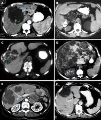 Maybe you would like to learn more about one of these? Rare Cystic Liver Lesions A Diagnostic And Managing Challenge