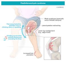Image result for Patella Grind Test