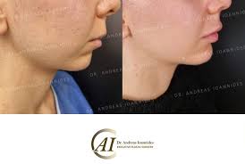 Chin Plastic Surgery