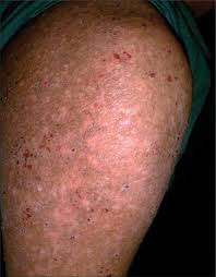 Image result for Typhus