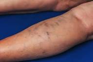 What is phlebitis, and what's the best treatment? : Vascular ...