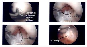 Graded 1, 2 or 3 depend on on severity of the injury. Case Study Anterior Cruciate Ligament Acl Reconstruction And Chondroplasty Of The Left Knee In A 30 Year Old Female