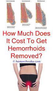 Pin On How Do I Know If I Have Hemorrhoids