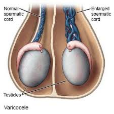 Image result for Varicocele