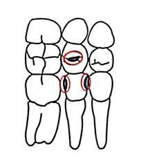 Dental Charting Flashcards Cram Com