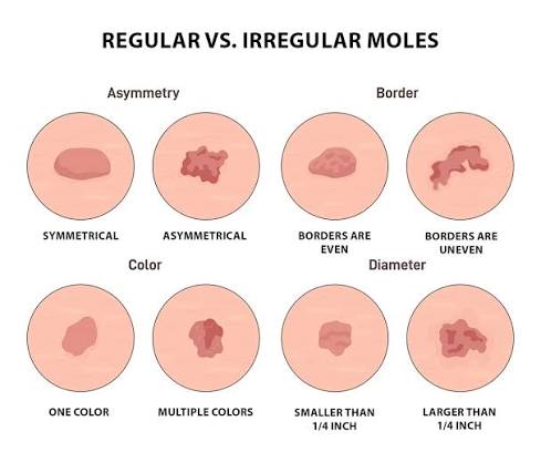 Mole Symptoms & Treatment | Aurora Health Care
