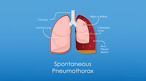 Image result for Pneumothorax