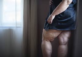 Liposuction for Lipedema: Overview of Effectiveness and Safety