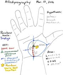 Somatosensory Rehabilitation For Allodynia In Complex Regional Pain Syndrome Of The Upper Limb A Retrospective Cohort Study Journal Of Hand Therapy