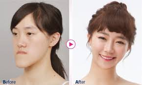 Cằm lồi có đẹp không? Khắc phúc bằng cách nào?