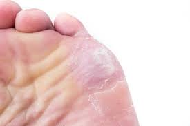 Por Que Se Pelan Los Pies Todas Las Causas
