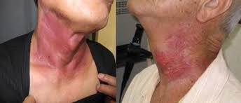 Image result for Radiation Dermatitis
