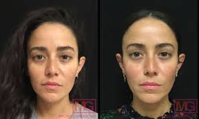 There is always a possibility of bruising with injections, especially the face since it is very vascular. Juvederm Nyc Juvederm Injections For Lines Wrinkles